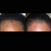 A picture of Jigger hair growth 15 000 ssp only