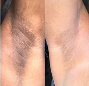A picture of Dark spot remover