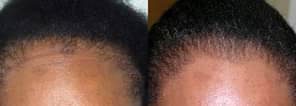 A picture of Anti Hair Loss BALD HEAD REGROWTH OIL SPRAY HAIR LINES
