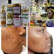 A picture of Zero Pimples Acne Warts Rash Dark spots Eczema