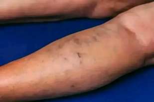 A picture of VARICOSE VEINS