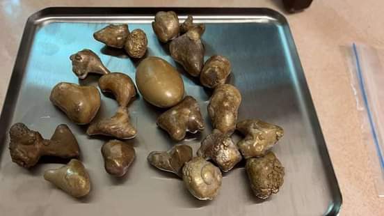 A picture of Cow gallstones