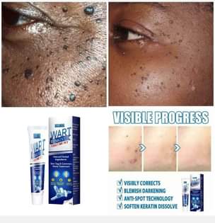 A picture of Warts remover