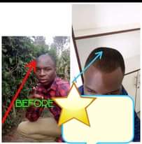 A picture of Baldness Essential Oils