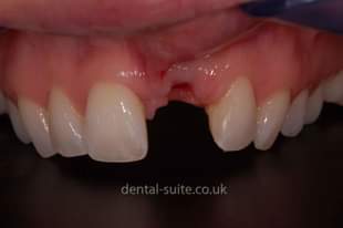 A picture of Missing teeth venners replacement