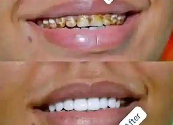 A picture of Teeth whitening