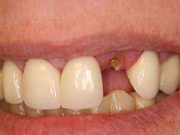 A picture of Teeth replacement and denture adhesive