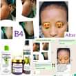 A picture of Zero Pimples Acne Warts Rash Dark spots Eczema