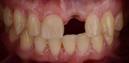A picture of Teeth replacement and denture adhesive