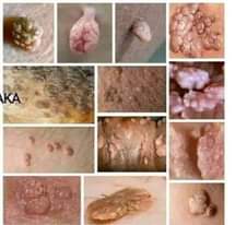A picture of Warts remover