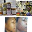 A picture of Zero Pimples Acne Warts Rash Dark spots Eczema