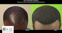 A picture of Anti Hair Loss BALD HEAD REGROWTH OIL SPRAY HAIR LINES