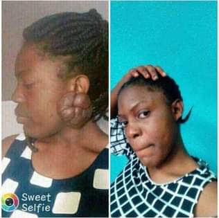 A picture of Keloids and scar cream