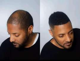 A picture of Baldness Hair Essentials