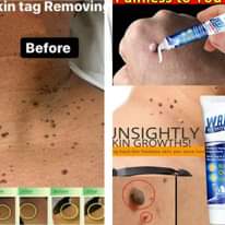 A picture of Warts remover
