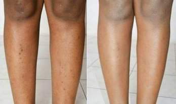 A picture of Dark spot remover