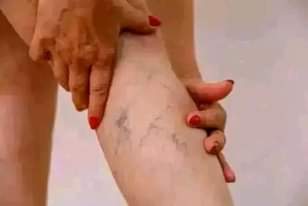 A picture of VARICOSE VEINS