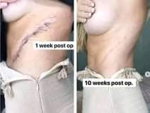 A picture of SCAR REMOVER
