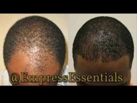 A picture of Jigger hair growth 15 000 ssp only