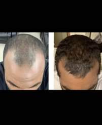 A picture of Minoxidil hair grow