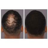 A picture of Anti Hair Loss BALD HEAD REGROWTH OIL SPRAY HAIR LINES