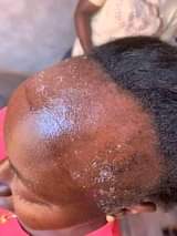 A picture of Hair Treatment Hair growth