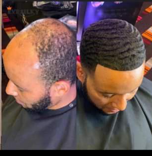 A picture of Neo hair grow