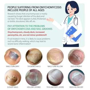 A picture of NAIL FUNGUS TREATMENT