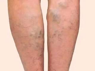 A picture of VARICOSE VEINS