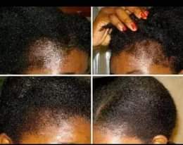 A picture of Neo hair grow