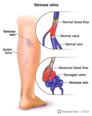 A picture of VARICOSE VEINS